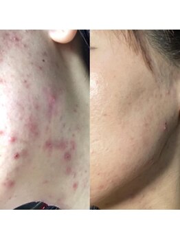 アニー(ANNIE)/HAAB REPRO