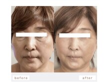 ラキネイ 目黒(Lakinei)/血流アップ透明感や色味の改善◎