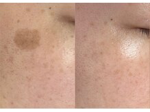 モガナ(mogana)/20代・シミケア10分スポットケア