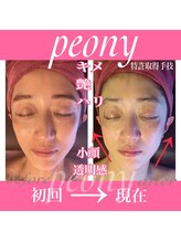 ピオニー(PEONY)/特許取得手技 小顔