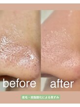 翡翠/頑固な小鼻の黒ずみ