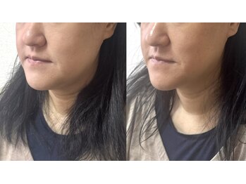 ルピナス 立川店/脂肪撃退アンプル