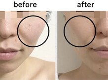 【30代から始める】エイジングが出来る肌質改善光フェイシャル☆