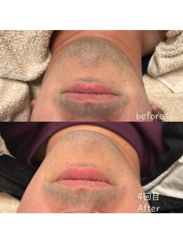 リリールア(Rere-Rua)/美肌メンズ脱毛