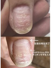 アーティネイルズ(Aaty Nails)/でこぼこ爪も改善症例あり