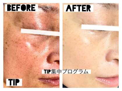 毛穴・エイジングケア専門｜ハーブピーリング｜salonsai｜シミ・美白・たるみの写真