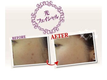 エステサロン シャイン/ハリツヤ★美顔