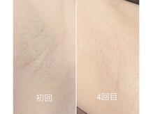 ジェシカ 荻窪店/荻窪/ワキ脱毛2