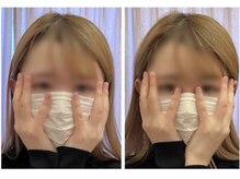 GINZA美容整体 コアのミ/初回の施術のBefore&after