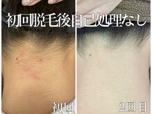 ニコ アンド キャンディー(Nico.&Candy)/本気で脱毛したい方募集！！