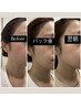《美容鍼初回》日焼け赤みニキビケア☆美容鍼+CICAパック90分￥8712→￥6512
