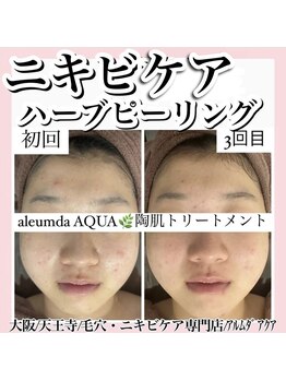 アルムダアクア 天王寺店(Aleumda AQUA)/ハーブピーリング/大阪/天王寺