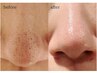 毛穴の開き/ザラつきが気になる方へ!肌診断付き小鼻アクアピュア毛穴洗浄★