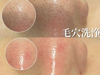 アイブロウサロン アヴィ(A‘VI)/小鼻毛穴洗浄