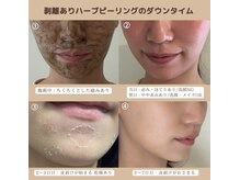 アイル 代々木上原店(iru)/ダウンタイム(皮剥け期間)