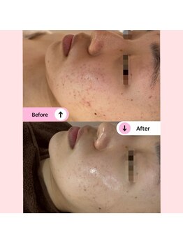 アネラ(ANELA)/ニキビケア