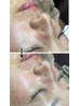 エステ人気No1、高濃度水素毛穴洗浄、お得な3回券＋高濃度エクソソームパック