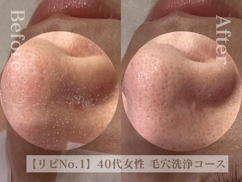 ディレイア ザ コスメ 有楽町マルイ店(direia the cosme)の写真/黒ずみ・ザラツキ・脂性肌の毛穴徹底改善【ウォーターピーリングで毛穴をリフレッシュ】[有楽町/毛穴/小顔]