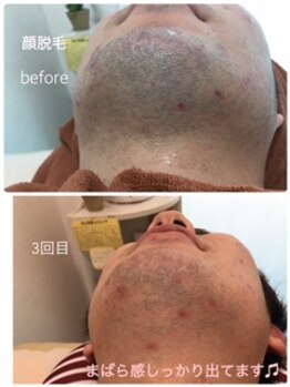 レイ バイ イルア(LEI by I’LUNA)/メンズのひげ脱毛でスッキリ★