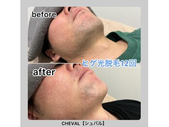シュバル(CHEVAL)/ヒゲ脱毛12回！