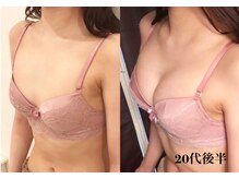 リール 新宿店(RIRE)/ 20代後半　バストアップ症例
