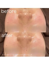 ルルラ リコ(lulula rico)/症例写真/ハーブピーリング