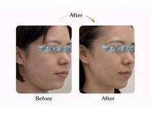 ラディアント たまプラーザ/スノーピール×サーマトリックス