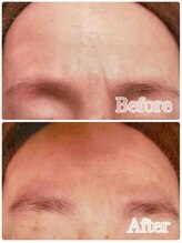 ブランシェ 富山店 × 椿/シワ・たるみケア　お客様