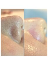 エミナル(Eminal)/◇毛穴エクストラクション ete式