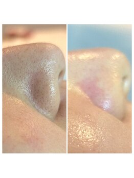 エミナル(Eminal)/◇毛穴エクストラクション ete式