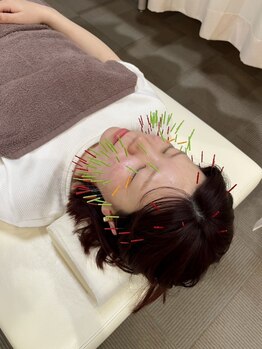 まごころ整骨院の写真/【TVで話題!】ハリネズミ美容鍼初回¥8250→¥6400★通常美容鍼よりも効果が期待◎エイジングケアにおすすめ!