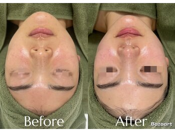 レイ(Lei)/ニキビ/毛穴/ハーブピーリング