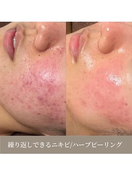 天使の艶肌 武蔵小杉店/繰り返しできるニキビに
