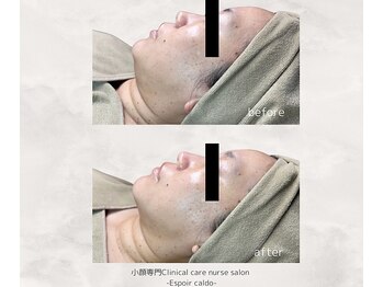 エスポワールカルド(Espoir caldo)の写真/≪褒められる小顔に≫美容看護師によるTOP技術★フェイスライン引き締め!!30代からの小顔リフトアップ♪