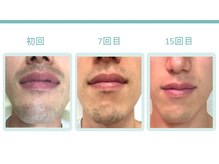 ハトロ(Hatoro)/ビフォーアフター