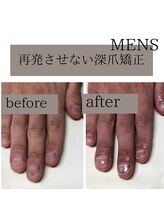 ティアラネイル(tiaranail)/再発させない深爪矯正