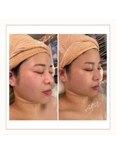 エメ(Aimer)/【20代EXフェイシャル結果☆】