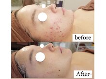 リアンビューティー(Lien Beauty)の雰囲気（【美肌革命★】グリーンハーブ2g 結果重視の本格ニキビケア♪）
