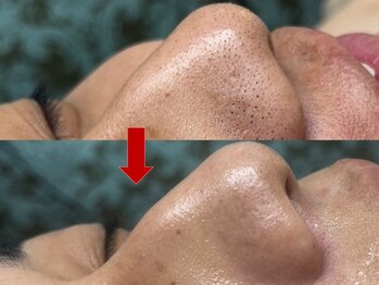 ブリリアン デイスパ 阪急西宮ガーデンズ店(BRILLIAN DAYSPA)/毛穴洗浄フェイシャル