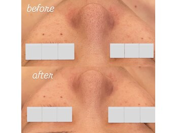 リノ(Lino)/自分では難しい毛穴ケア！