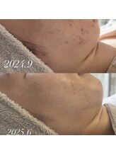 アリア(allia)/ニキビケア、シミケア