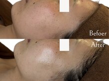 お肌の引締め・たるみ改善★一度の施術で納得の小顔へ♪