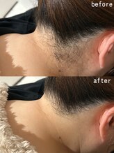 スパ ナナプラス(SPA nana+)/全身脱毛