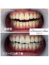 ホワイトニングサロン 京都烏丸店/ホワイトニング施術例