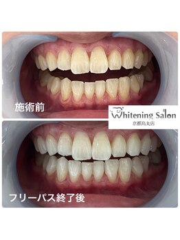 ホワイトニングサロン 京都烏丸店/ホワイトニング施術例