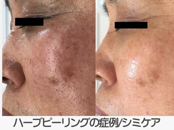 ラ コケット(La Coquette)/エルモサ/ハーブピーリング