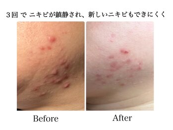 ナチュラーレ 天王寺店(Naturale)/美肌ニキビケア小顔フェイシャル
