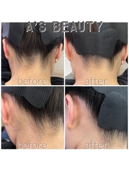 エース ビューティー(A’s)/うなじ脱毛