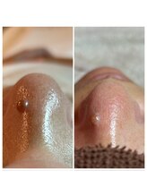 エミナル(Eminal)/◇毛穴エクストラクションtete式