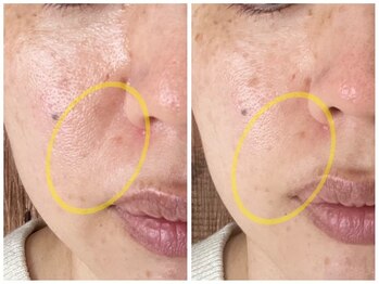 小顔フェイスラボ 鈴鹿店(小顔FaceLabo.)/◆たるみ・ほうれい線改善◆